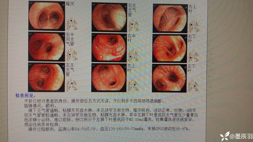 罗定首例无症状感染者来源公布/罗定出现新型冠状病毒感染者