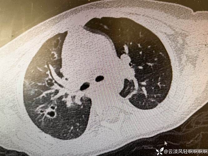 【湖南省衡阳市珠晖区近7天新增6例涉8省输入病例,湖南衡阳珠晖区有新型肺炎】