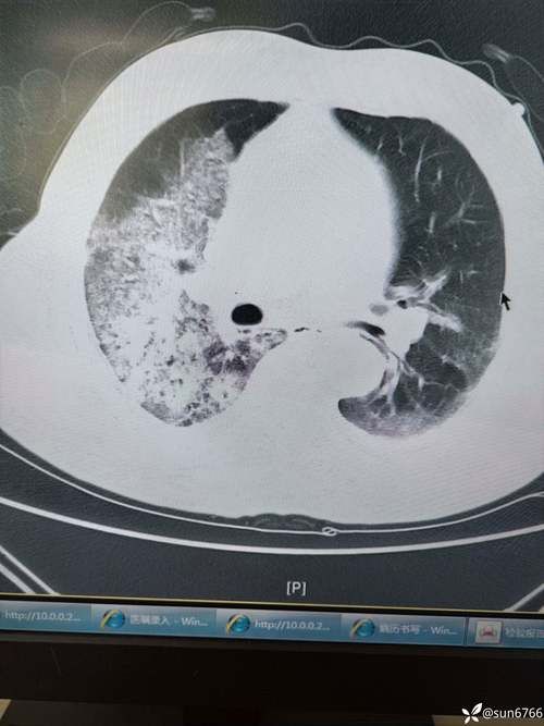 湖南怀化新晃侗族自治县昨日新增10例阳性感染者:湖南新晃县新型肺炎