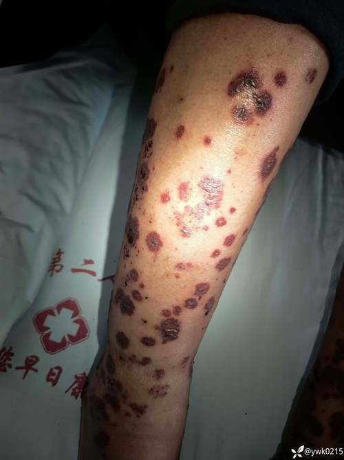 湖北襄阳保康县现有阳性感染者15例(湖北襄阳宝康县)