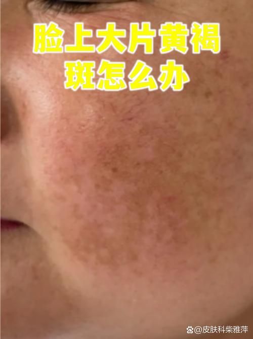 多地新增重症18例_脸上长黄褐斑看什么科